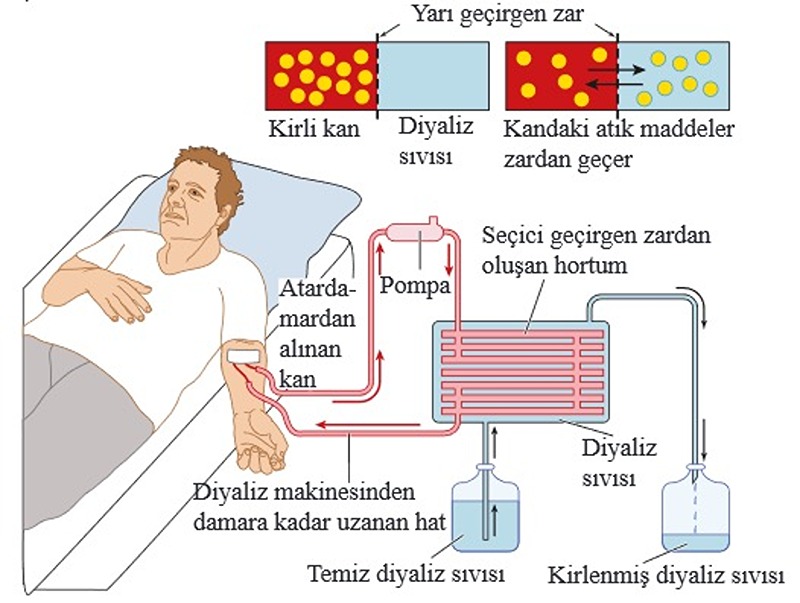 Diyaliz Nedir