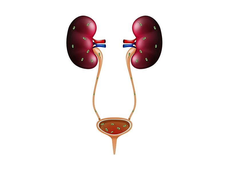 Diyaliz Hastalarında Hangi Kanserler Daha Sık Görülür?