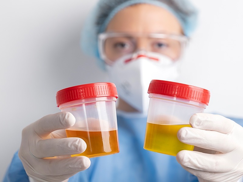 İdrarda Renk Değişikliği Nedenleri