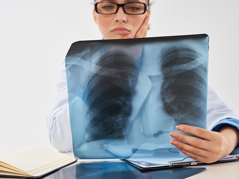 COVID 19 da Kontrol Akciğer Tomografisi Ne Zaman Çekilir?