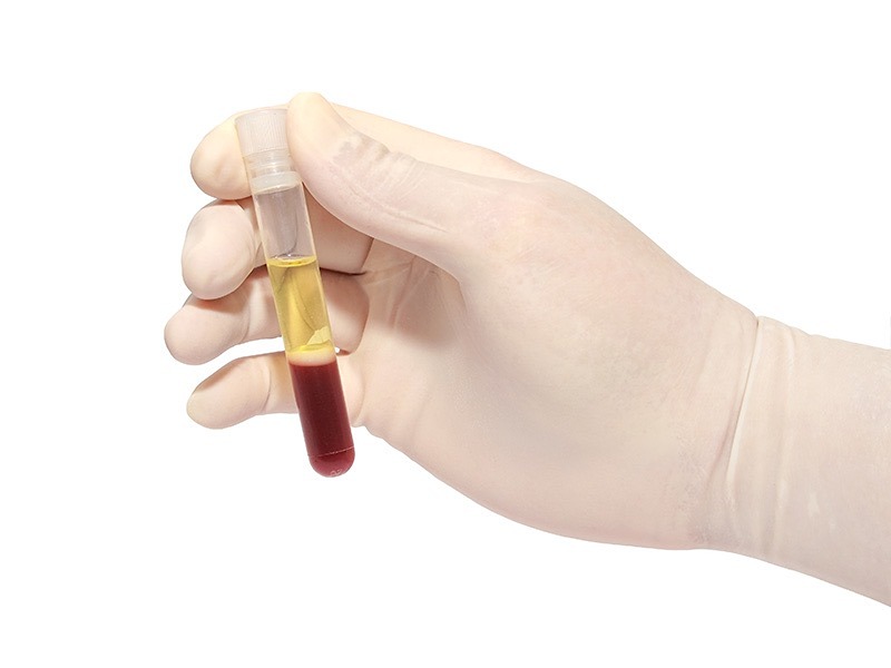 Trombositte Zengin Plazma (PRP)